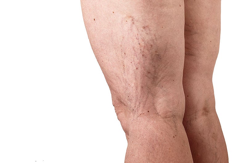 Close-up view of a patient presenting spider veins on the leg during an evaluation for vascular care