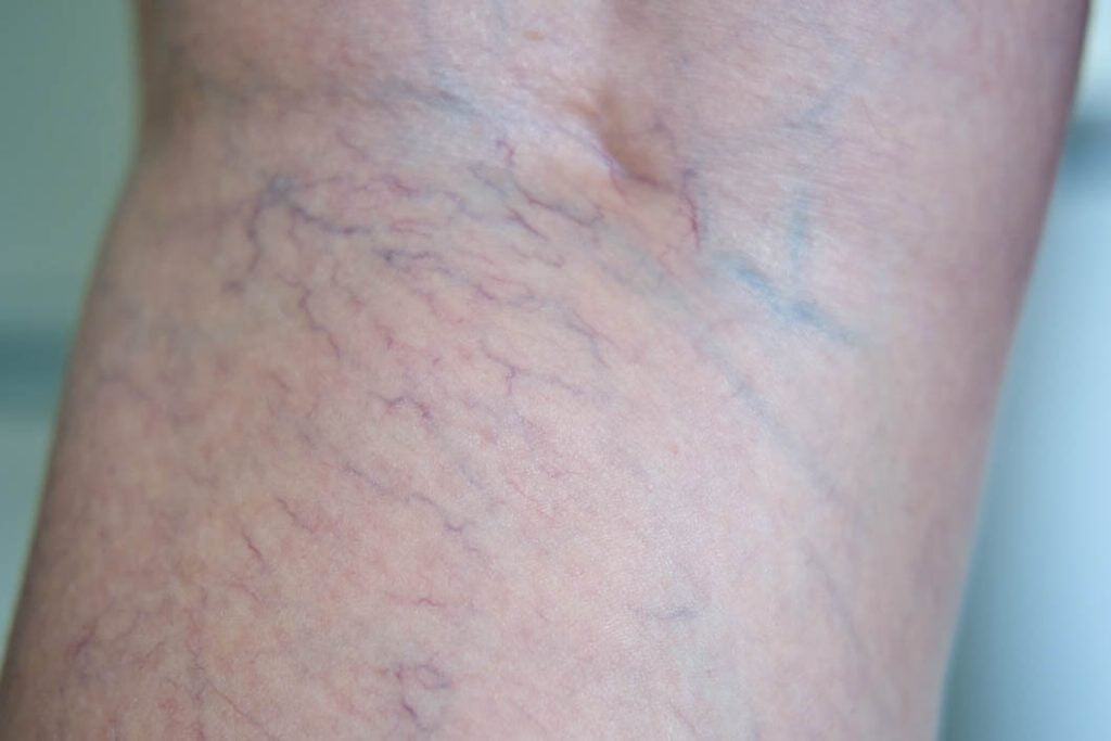 Close-up view of visible spider veins on a patient's leg related to venous disease